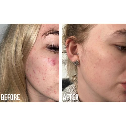 Nip+Fab Retinol Fix Blemish Gel Treatment 10% Complex, 0.5 fl. oz., 0.1% Ensapsulated Pure Retinol, 2% Niacinamide, 2% Trivalin, 0.5% Salicylic Acid to Target Blemishes, Dark Spots and Pore Size