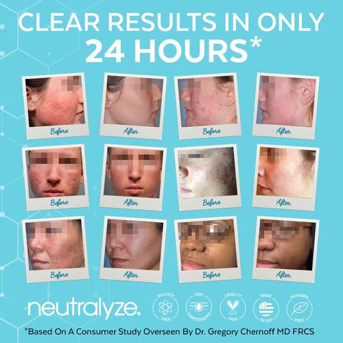 Neutralyze Moderate To Severe Acne Treatment Kit 2.0 (Clearing Serum & Synergyzer)