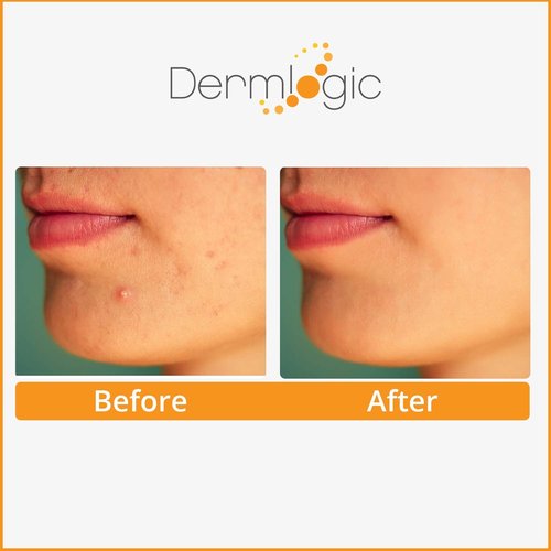 Dermlogic Acne Treatment Pads-Contains Glycolic, Lactic, Salicylic Acid. Eliminates Oily Skin, Clogged Pores & Cystic Breakouts. Removes Dark Spots, Whitehead & Blackhead Pimples for Face & Body.