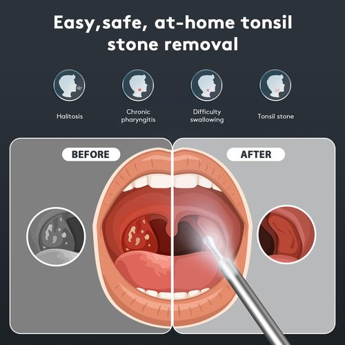Tonsil Stone Remover with Camera - 1296P HD Larger View & Clearer Images Tonsil Stone Remover Kit with LED Light Tonsillolith Removal Tool Tonsil Cleaner with 3 Heads, Tonsil Stone Syringe (White)