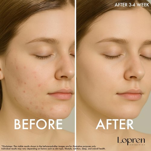 Lopren AHA 10% BHA 2% Exfoliating Serum, Skin Smoothing & Pore Refining Facial Serum, Supports a Clearer Complexion, 1 Fl Oz