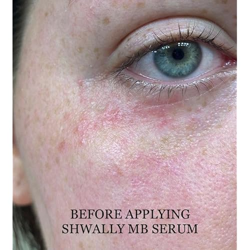 Shwally Methylene Blue Serums (Blue Extra Potency Spot Treatment, 1oz)