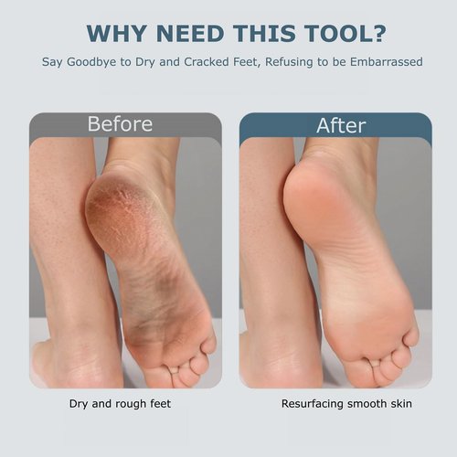 Upgraded Electric Foot Callues Remover, Portable Electric Foot Files with 3 Heads, Rechargeable Feet File for Foot Care, Waterproof Deadskin Remover, Pedicure Tool for Dry and Crack Feet
