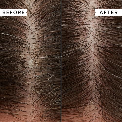 PHILIP KINGSLEY | Flaky Scalp Shampoo | Shampoo For Flaky, Itchy, Dry, Oily Scalps | Cleansing Scalp Care | Hair Shampoo that Hydrates, Soothes and Calms | 1L Pump