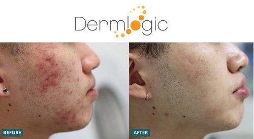 Dermlogic Acne Treatment Pads-Contains Glycolic, Lactic, Salicylic Acid. Eliminates Oily Skin, Clogged Pores & Cystic Breakouts. Removes Dark Spots, Whitehead & Blackhead Pimples for Face & Body.