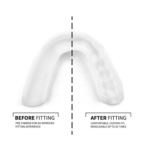 SOVA 3D Night Guard - 2.0mm Thin - Custom-Molded Fit - Protects Against Nighttime Teeth Grinding & Clenching - FSA/HSA Eligible - Odor & Taste Free - Remoldable Up to 20 Times - Non Toxic