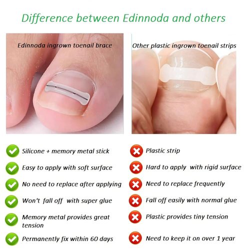 Edinnoda Ingrown Toenail Corrector | Toe Nail Brace for Curved Toe Nail | Toe Nail Lifter for Ingrown Treatment (Adult Largest Toenail Only) (Upgraded Brace, Patent Pending) (20 mm)