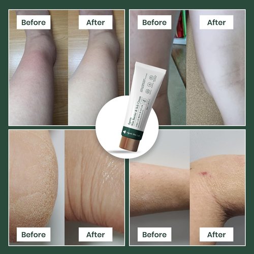 AGERIN Anti-Itch Cream – Skin Barrier and Itch Relief Cream for Sensitive and Dry Skin, Trouble Care, Calming, Hydrating, Purifying, Cruelty Free, Vegan