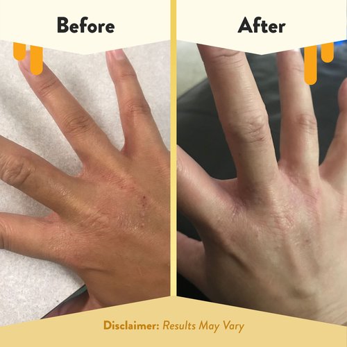 ECZEMA HONEY Premium Witch Hazel & Aloe Spray & Oatmeal Body Lotion - Natural Dry Skin Repair - For Senstive Skin