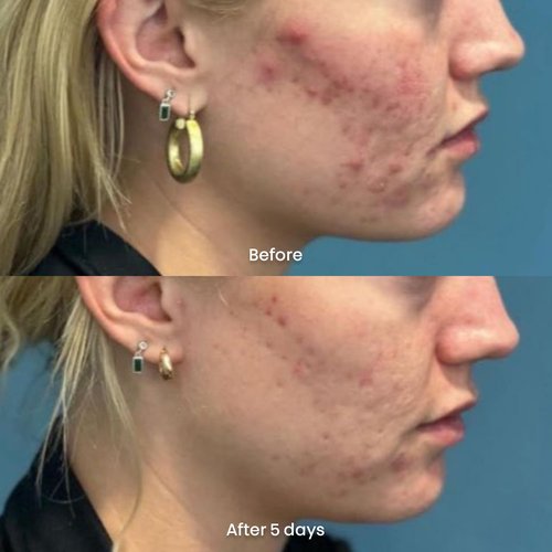 ORBE Derma Solutions Orbe It! 2-Step Acne Treatment – Clears, Treats & Prevents Acne & Helps Unclog Pores with 2% Salicylic Acid – Includes Cleansing Spray 1 oz & Treatment Cream 1 oz