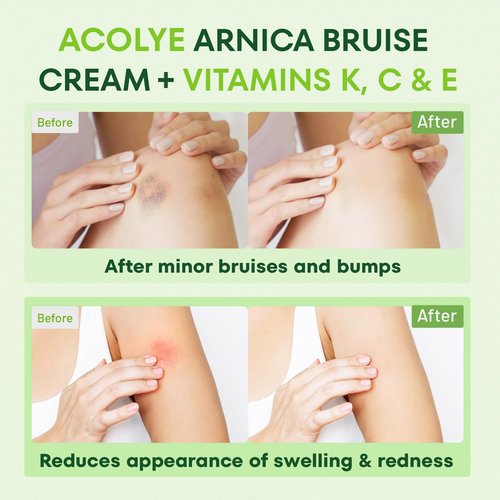 Acolye Arnica Cream for Bruising and Swelling: Extra Strength Arnica Bruise Cream with Vitamins K C E for Sports Enthusiasts - Fast Absorbing Formula Ideal for Post-Sport Recovery 3.5 Oz