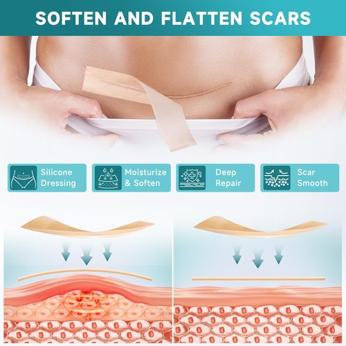 Silicone Scar Sheets, Silicone Scar Tape(5.7” x 1.57” 10 Pcs), Scar Removal Away Strips for Surgical Scars, Keloid, C-Section, Burn et