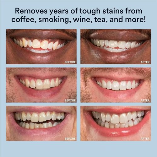 WHITE SMILE Teeth Whitening Kit, LED Light System, 35% Carbamide Peroxide 3 Gel Syringes, 10-Minute Treatment, Non-Sensitive Formula