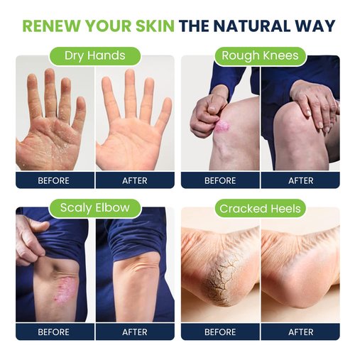 Tea Tree Oil Foot Balm/Moisturizer For Dry Cracked Feet - Instantly Hydrates & Soothes Irritated Skin & Athletes Foot & Tea Tree Oil Foot Cream Heel & Callus Removal, Toenail Treatment