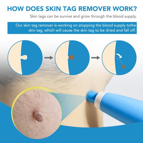 Skin Tag Remover Device FDA-Cleared Safe and Effective Skin Tag Removal Kits Home Use