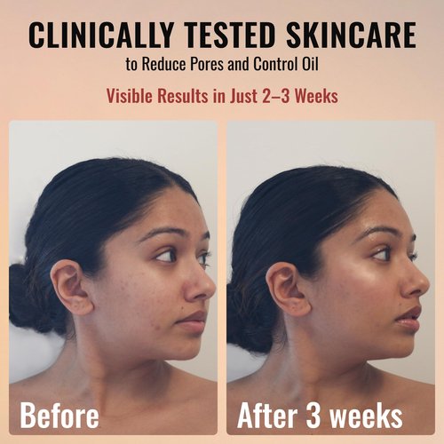 ADM Anti Aging Pure Retinol Serum For Face with Niacinamide - Resurfacing, Smoothing Fine Lines, Wrinkles, Acne Scars - Moisturizing Facial Skincare Treatment for Sensitive Skin - 1oz