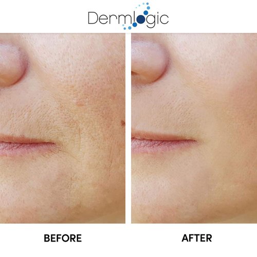 Anti Aging Resurfacing Peel Pads - Contains Salicylic, Glycolic, & Lactic for Face, Neck & Décolleté. Exfoliates, Brightens, Tones the Skin & Reduces Dark Spot, Fine Lines & Wrinkles for Radiant Glow.