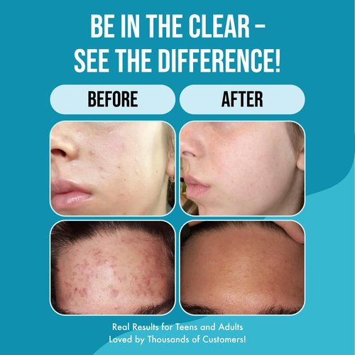 Teenology Gentle Face Cleanser for Teens - Helps with Acne and Breakouts - Fresh Papaya Scent 6 Ounce