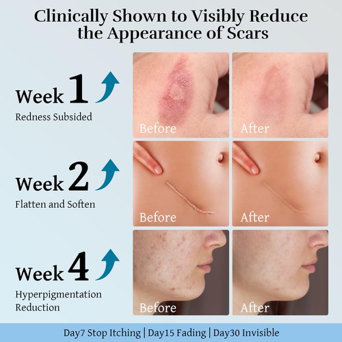 Advanced Scar Cream, Scar Reduction Treatment for Improves Skin Texture & Helps Remove Acne, Stretch Marks, Surgery, C Section, Burn, Keloid & Hypertrophic Scars 1.76 Oz (50g)