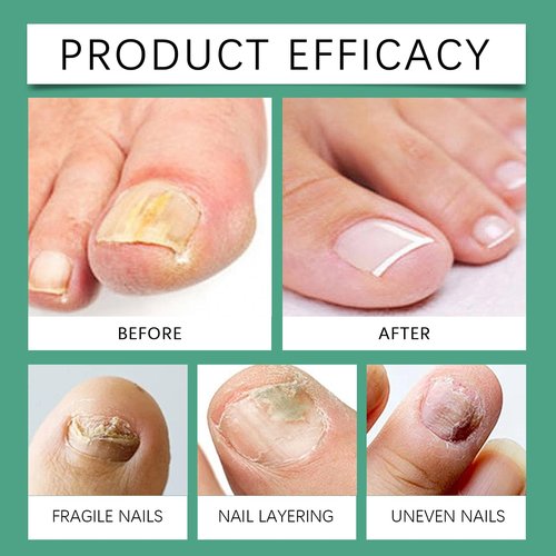 Orivelle Nail Fungus Pen,Nail Care Pen for Damaged Nails, Nail Revitalizing Serum to Help Repair & Strengthen Nails, Support Healthy Growth for Toenails and Fingernails (3 PCS)