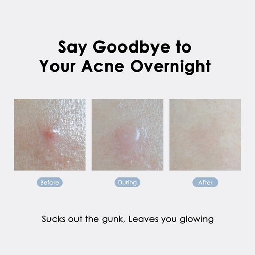 glowiest ASAP Active Spot Alleviating Patch [Bedtime] 52 Patches 8mm (16ea), 10mm (20ea) & 12mm (16ea) | Premium Hydrocolloid Dressing | Simple & Easy Active Treatment (Pack of 2)