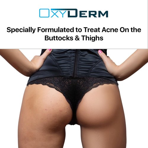 Butt & thigh Acne Treatment Pads - Exfoliating Pads to Eliminate Acne Causing Bacteria. Removes Pimples, Blemishes & Ingrown Hairs for the Buttocks & Thigh Area for Both Men & Women.