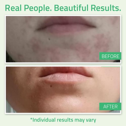 YEOUTH Glycolic Acid Peel for Face, At Home Chemical Exfoliator AHA 30% Glycolic Acid Face Peel with Retinol, Designed to Refresh and Smooth the Appearance of Skin 2oz