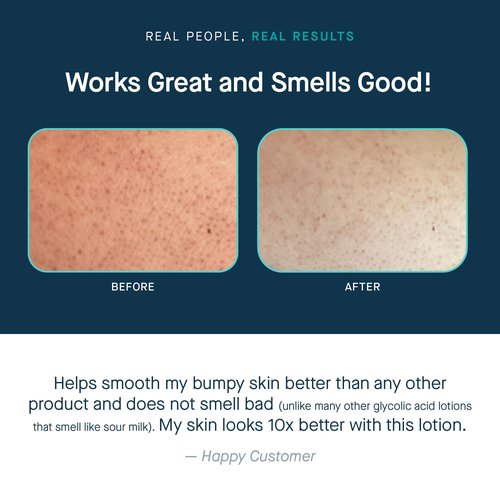 SLMD by Dr. Pimple Popper | Glycolic Acid Body Lotion | Exfoliating Glycolic Acid Lotion Body for Rough, Bumpy Skin and Skin Prone to KP, Ingrown Hairs, Shaving Bumps | 10% AHA - 6 fl. oz.