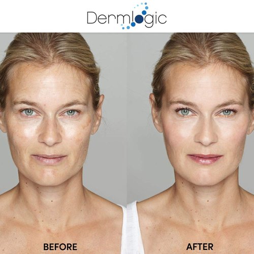 Anti Aging Resurfacing Peel Pads - Contains Salicylic, Glycolic, & Lactic for Face, Neck & Décolleté. Exfoliates, Brightens, Tones the Skin & Reduces Dark Spot, Fine Lines & Wrinkles for Radiant Glow.