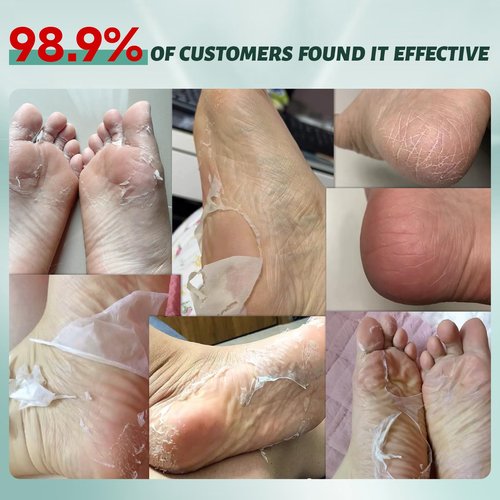 VGO 7 Pack Foot Peeling Mask, Natural Exfoliating Foot Mask, Dead Skin Callus Remover Repair Heels, Smooth Touch Feet, Hydrating Foot Care for Dry Cracked Feet