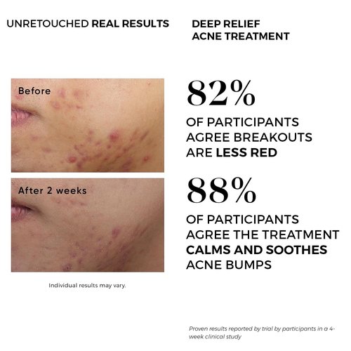 Dermlogic Acne Treatment Pads-Contains Glycolic, Lactic, Salicylic Acid. Eliminates Oily Skin, Clogged Pores & Cystic Breakouts. Removes Dark Spots, Whitehead & Blackhead Pimples for Face & Body.