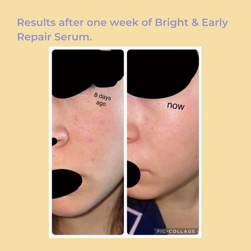 Evre Bright & Early Teen Vitamin C Repair Serum, Brightens, Hydrates & Evens Skin Tone, Natural, Cruelty-Free & Palm-Free, Great for Sensitive Skin, 1 Fl Oz
