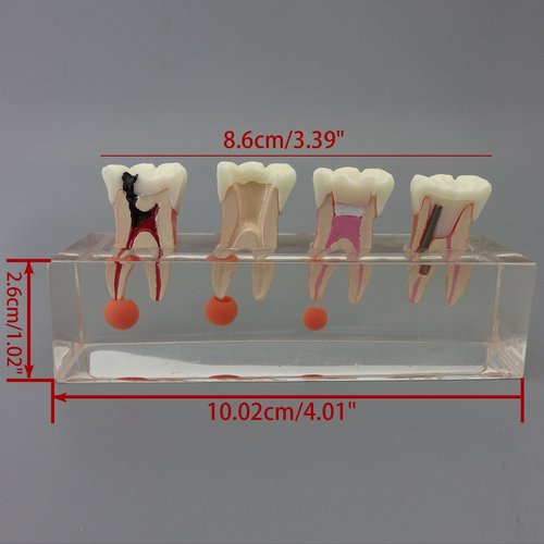 Dental Teeth Model 4-Stage Endodontic Treatment Model for Studying and Teaching …