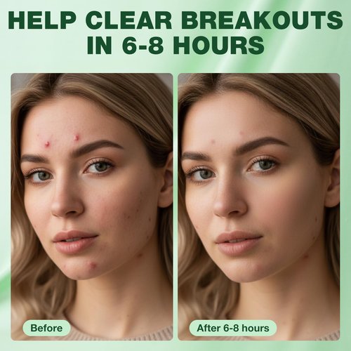 JOVS Pimple Patches for Face, 166 Ultra-Fine Points Per Patch, Support for Blemishes and Breakouts, 30 Patches (Early Pimples)