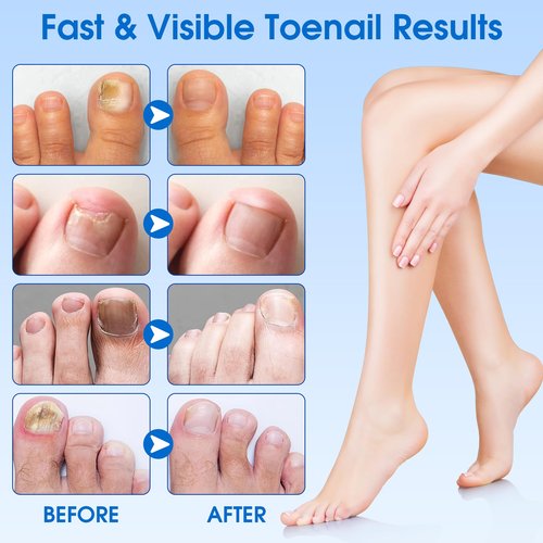 EASICUTI Fungal Nail Patches, 60 PCS Toenail Treatment Extra Strength, Overnight Nail Repair Sticks for Damaged Nails, Men and Women