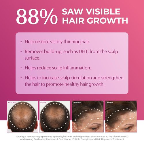 BosleyMD Foam, Extra Strength Thinning Treatment for Hair Loss and Hair Regrowth for Women 2%-5% Topical Solution, Foam/Mousse, 1-month supply, 2 oz