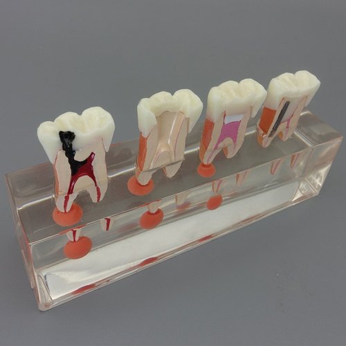 Dental Teeth Model 4-Stage Endodontic Treatment Model for Studying and Teaching …