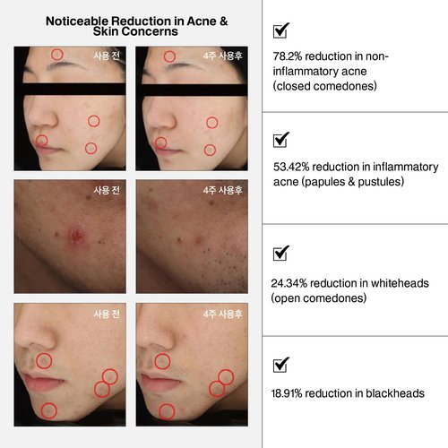 NURICLE BETELCHLOROUS S.O.S Rescue Dose 30ml(1.014 fl.oz) – Hypochlorous Acid Face Serum for Acne, Redness & Sensitive Skin – Korean Skin care Calming Serum