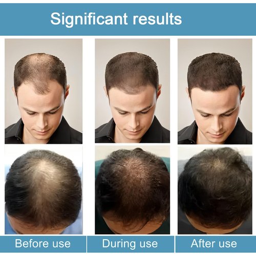 Hair Regrowth System, Advanced Hair Growth Treatment Ginseng, Eclipta Prostrata, Peppermint Oil and Ginger Root, Treatment for Thicker, Strengthens Roots,for Men and Women 1pcs