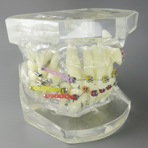 Smile1000 Dental Malocclusion Orthodontic Treatment Teeth Model with Metal Brackets Wires Colorful Ties Chains and Hoops M3005