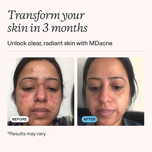 MDacne Salicylic Acid 2.0% - Acne Treatment Cream, Facial Exfoliant Unclog Pores, Prevents Blemishes, Blackheads, Wrinkles & Fine Lines, Reduce Irritation for Sensitive Acne-Prone Skin (1 Pack)