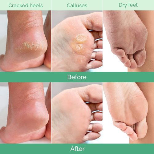 PLANTIFIQUE Foot Peeling Mask 4 Pack | Dermatologically Tested Repairs Heels & Removes Dry Dead Skin for Baby Soft Feet | Exfoliating Foot Peel Mask for Dry Cracked Feet | Peach