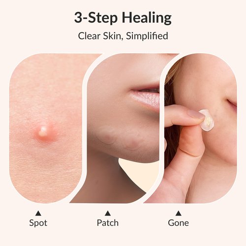 RPE Life Invisible Pimple Patches – 4 Sizes Miracle Patches for Pimples with Hydrocolloid & Salicylic Acid, Korean Acne Patches for Face, Zit Stickers, Blemish Patches, Acne Spot Dots – 144 Count