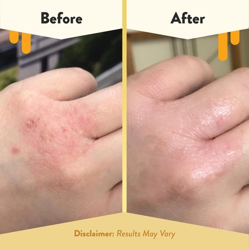 ECZEMA HONEY Original Skin-Soothing Cream & Oatmeal & Lavender Soap - Bundle for Sensitive Dry & Skin - Cruelty Free