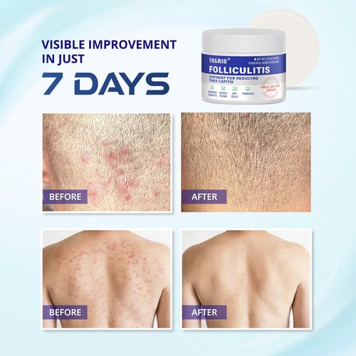 TAGRID Folliculitis Treatment Cream, Ingrown Hair Treatment, Soothing Scalp, Face & Body Cream - Hydrating & Refreshing - – Ultimate Duo