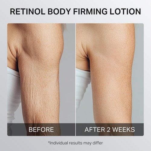 Ultra-Size Firming Retinol Body Lotion for Crepey Skin & Keratosis Pilaris with 0.05% Retinol, AHA, Collagen, Body Cream, Anti Aging Moisturizer 10.14 fl oz