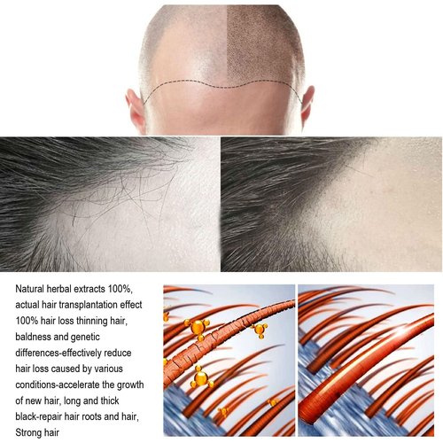Hair Regrowth System, Advanced Hair Growth Treatment Ginseng, Eclipta Prostrata, Peppermint Oil and Ginger Root, Treatment for Thicker, Strengthens Roots,for Men and Women 1pcs
