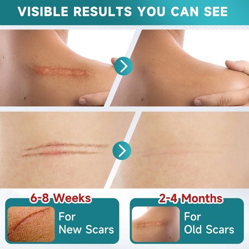 Silicone Scar Sheets, Silicone Scar Tape(5.7” x 1.57” 10 Pcs), Scar Removal Away Strips for Surgical Scars, Keloid, C-Section, Burn et