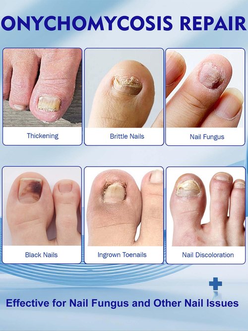 Nail Patches 48 PCS Toenail Treatment Extra Strength 8-Hour Overnight Nail Fast Acting Repair Effortless Hydrogel Nail Care and Repair for Damaged Nails Overnight Renewal for Men and Women