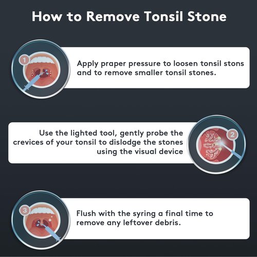 Tonsil Stone Remover with Camera - 1296P HD Larger View & Clearer Images Tonsil Stone Remover Kit with LED Light Tonsillolith Removal Tool Tonsil Cleaner with 3 Heads, Tonsil Stone Syringe (White)